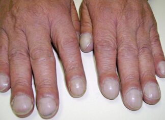 “Look Out for the ‘Drummer’s Finger’ Sign: A Simple Method to Detect Early Warning Signs of Lung Cancer and Cardiovascular Disease”