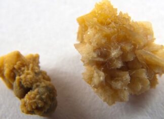 Slash Kidney Stone Risk by 40% with Daily Coffee