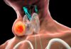 8 Early Warning Signs of Thyroid Cancer: What to Look Out For