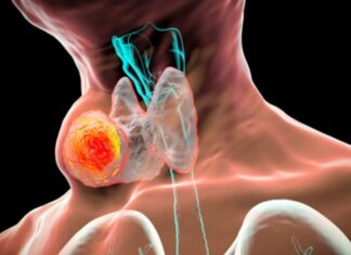 8 Early Warning Signs of Thyroid Cancer: What to Look Out For