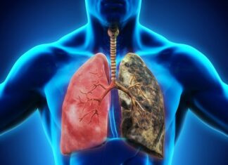 8 Warning Signs of Lung Cancer You Shouldn’t Ignore
