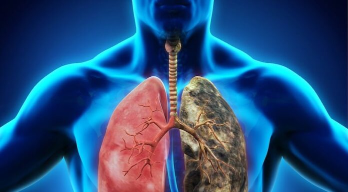 8 Warning Signs of Lung Cancer You Shouldn’t Ignore