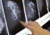 “A Hanoi Woman’s Battle with Bilateral Breast Cancer: Ignoring Two Major Warning Signs”