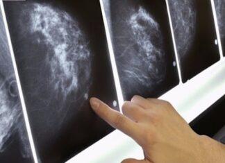 “A Hanoi Woman’s Battle with Bilateral Breast Cancer: Ignoring Two Major Warning Signs”