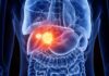 9 Early Warning Signs of Liver Cancer That Should Not Be Ignored