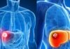 5 High-Risk Groups for Liver Cancer: Screening is a Must