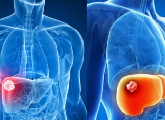 5 High-Risk Groups for Liver Cancer: Screening is a Must