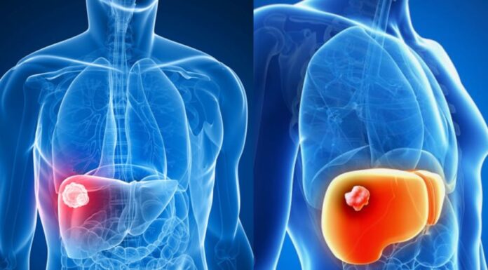 5 High-Risk Groups for Liver Cancer: Screening is a Must