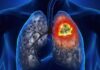 7 Early Warning Signs of Lung Cancer: Don’t Ignore, Get Checked Now!