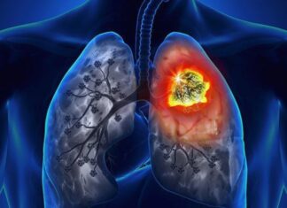 7 Early Warning Signs of Lung Cancer: Don’t Ignore, Get Checked Now!