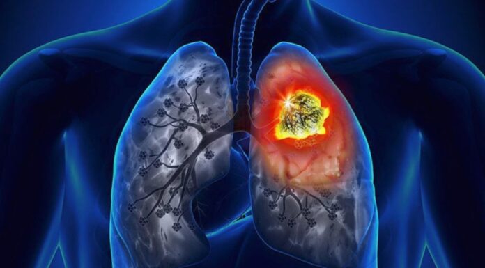 7 Early Warning Signs of Lung Cancer: Don’t Ignore, Get Checked Now!