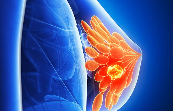 Two Terrible Habits of Husbands That Increase Their Wives’ Risk of Breast Cancer: Stop Now for Your Family’s Sake!