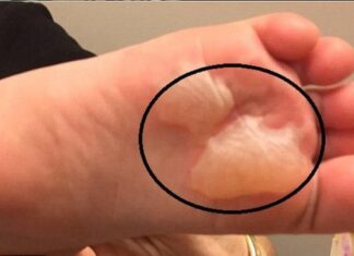 “Soothing Relief for Blistered Feet: Expert Tips for Happy Hiking”