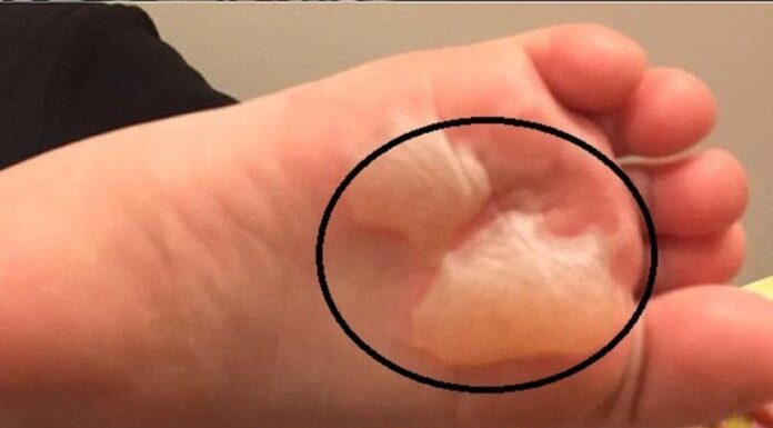 “Soothing Relief for Blistered Feet: Expert Tips for Happy Hiking”