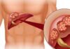 7 Groups Who Should Get Screened for Liver Cancer to Protect Their Health