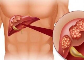 7 Groups Who Should Get Screened for Liver Cancer to Protect Their Health