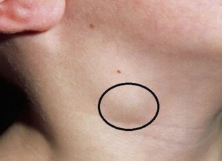 3 Unusual Signs at the Neck: A Warning for an Impending Health Disaster