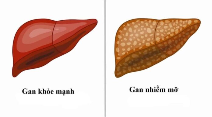 Does Fatty Liver Cause Liver Cancer? Expert Reveals Signs You Need to Know.