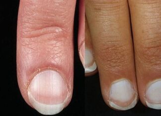 10 Warning Signs of Liver Disease That May Be Visible, But Often Overlooked