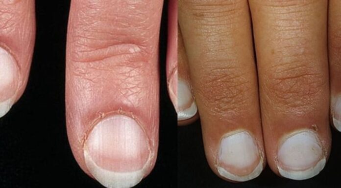 10 Warning Signs of Liver Disease That May Be Visible, But Often Overlooked