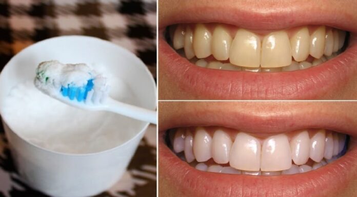 Teeth Whitening: Brush with This to Remove Stains and Plaque Without Enamel Erosion.