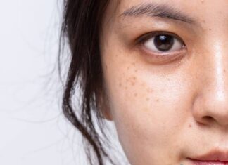“The Ultimate Guide to Fading Age Spots and Freckles for a Brighter, More Youthful Complexion”