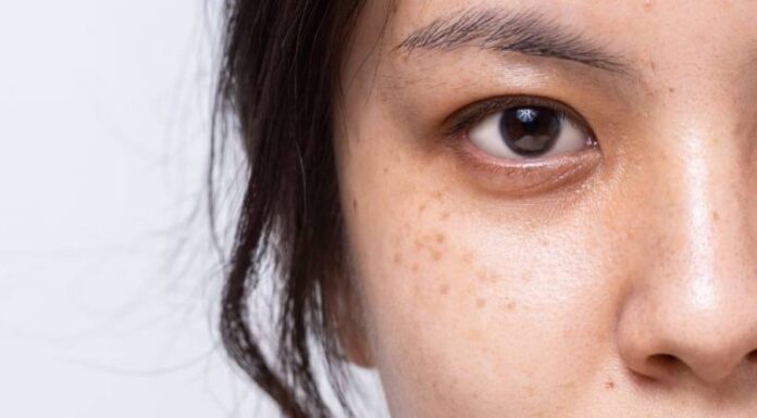 “The Ultimate Guide to Fading Age Spots and Freckles for a Brighter, More Youthful Complexion”
