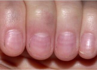 The Ultimate Guide to Health Diagnosis Through Nail Analysis
