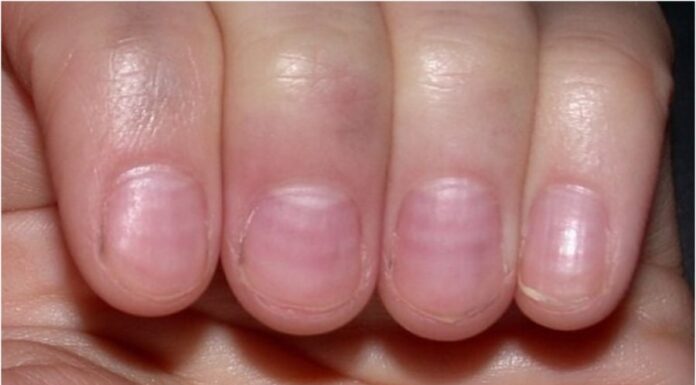 The Ultimate Guide to Health Diagnosis Through Nail Analysis