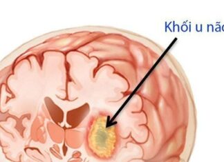 8 Warning Signs of Brain Tumors: Be Alert to These Red Flags