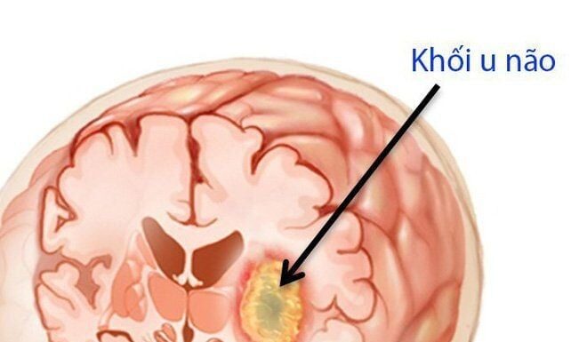 8 Warning Signs of Brain Tumors: Be Alert to These Red Flags