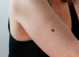 Warning: Tiny Spots on Your Skin Could Be a Sign of Cancer – Stay Vigilant