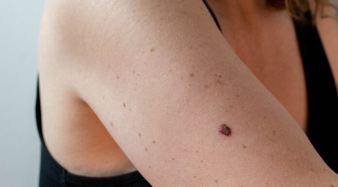Warning: Tiny Spots on Your Skin Could Be a Sign of Cancer – Stay Vigilant
