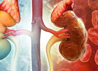 8 Warning Signs of Early-Stage Kidney Disease: Ignoring These May Lead to a Lifetime of Dialysis