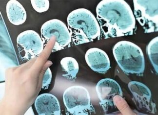 6 Golden Habits for Seniors to Reduce the Risk of Stroke – How Many Do You Have?