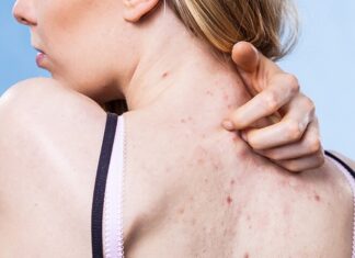 5 Bad Habits That Are Causing Your Back Acne and How a Simple Change in Your Shampoo Routine Can Help