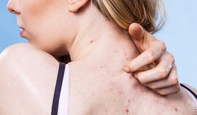 5 Bad Habits That Are Causing Your Back Acne and How a Simple Change in Your Shampoo Routine Can Help