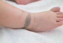 Warning: Moles, Birthmarks, and Lesions on Children May Indicate Underlying Health Issues