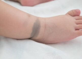Warning: Moles, Birthmarks, and Lesions on Children May Indicate Underlying Health Issues