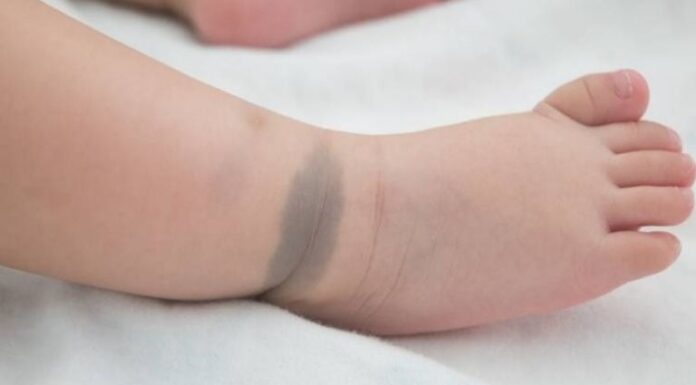 Warning: Moles, Birthmarks, and Lesions on Children May Indicate Underlying Health Issues
