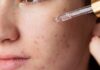 How Should Acne-Prone Skin Use Retinol?