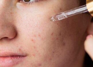 How Should Acne-Prone Skin Use Retinol?