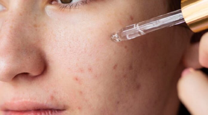 How Should Acne-Prone Skin Use Retinol?