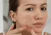The Ultimate Guide to Tackling Those Pesky Pimples