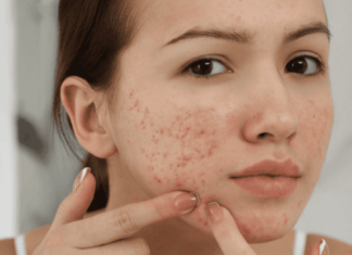 The Ultimate Guide to Tackling Those Pesky Pimples