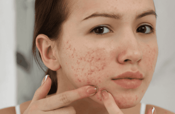 The Ultimate Guide to Tackling Those Pesky Pimples