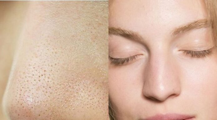 3 Tried-and-True Tips to Tackle Blackhead Woes Without Breaking the Bank