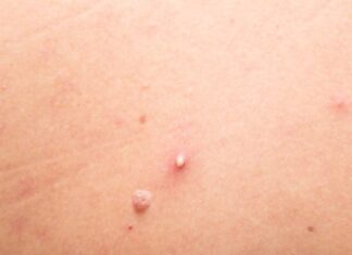 Effective and Quick Tips to Treat Whiteheads