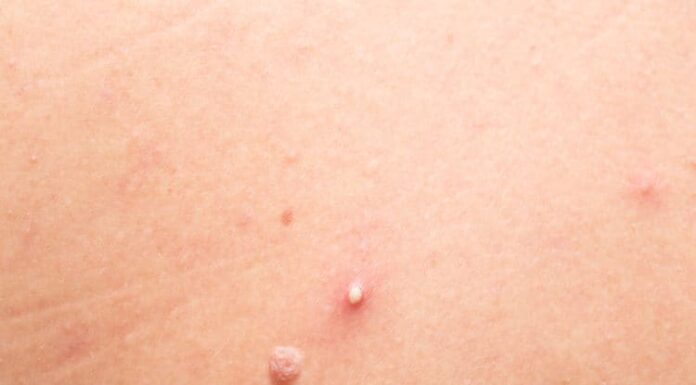 Effective and Quick Tips to Treat Whiteheads