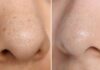 Clearer Skin, Smoother Nose: Effective Blackhead Removal and Skin Smoothing Techniques